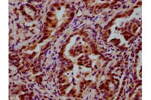 IHC image of ABIN7174204 diluted at 1:600 and staining in paraffin-embedded human lung cancer performed on a Leica BondTM system. (NAA38 antibody  (AA 2-96))