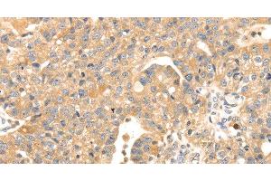 Immunohistochemistry of paraffin-embedded Human breast cancer tissue using S100A12 Polyclonal Antibody at dilution 1:45 (S100A12 antibody)