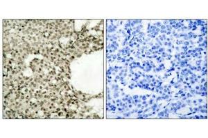 Immunohistochemical analysis of paraffin-embedded human breast carcinoma tissue using STAT1 (phospho- Ser727) antibody (E011163). (STAT1 antibody  (pSer727))