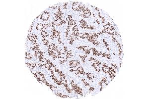 Strong INSM1 immunostaining in a low grade neuroendocrine tumor of the appendix (Recombinant INSM1 antibody  (AA 81-125))