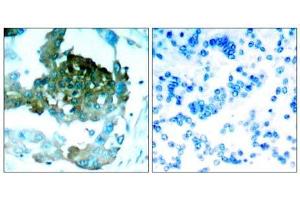 Immunohistochemical analysis of paraffin-embedded human lung carcinoma tissue, using PKCθ (Ab-695) antibody (E021185). (PKC theta antibody)
