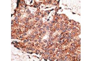 IHC analysis of FFPE human breast carcinoma tissue stained with the BMP1 antibody (BMP1 antibody  (AA 957-986))