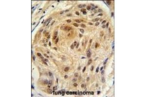 Formalin-fixed and paraffin-embedded human lung carcinoma tissue reacted with LSM1 antibody (C-term) (ABIN389386 and ABIN2839481) , which was peroxidase-conjugated to the secondary antibody, followed by DAB staining. (LSM1 antibody  (C-Term))