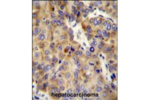 COL18A1 Antibody immunohistochemistry analysis in formalin fixed and paraffin embedded human hepatocarcinoma followed by peroxidase conjugation of the secondary antibody and DAB staining. (COL18A1 antibody  (AA 1311-1339))