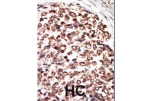 Formalin-fixed and paraffin-embedded human cancer tissue reacted with the primary antibody, which was peroxidase-conjugated to the secondary antibody, followed by AEC staining. (PRKD3 antibody  (C-Term))