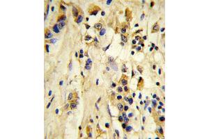 Formalin-fixed and paraffin-embedded human breast carcinoma reacted with EIF4E2 Antibody, which was peroxidase-conjugated to the secondary antibody, followed by DAB staining.