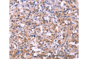 Immunohistochemistry of Human thyroid cancer using MMP14 Polyclonal Antibody at dilution of 1:40 (MMP14 antibody)