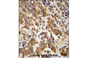 GK Antibody (C-term) (ABIN651665 and ABIN2840349) immunohistochemistry analysis in formalin fixed and paraffin embedded human cervix carcinoma followed by peroxidase conjugation of the secondary antibody and DAB staining. (GKAP1 antibody  (C-Term))