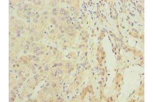 Immunohistochemistry of paraffin-embedded human liver cancer using ABIN7144623 at dilution of 1:100