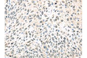 The image on the left is immunohistochemistry of paraffin-embedded Human lung cancer tissue using ABIN7128027(TCEB1 Antibody) at dilution 1/40, on the right is treated with fusion protein. (TCEB1 antibody)