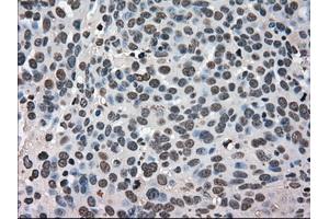Immunohistochemical staining of paraffin-embedded Adenocarcinoma of breast tissue using antiHSPA9 mouse monoclonal antibody. (HSPA9 antibody)