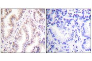 Immunohistochemistry analysis of paraffin-embedded human lung carcinoma tissue using PIAS1 antibody. (PIAS1 antibody  (N-Term))