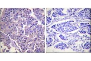 Immunohistochemistry analysis of paraffin-embedded human breast carcinoma tissue, using Caldesmon (Ab-789) Antibody.