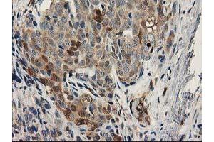 Immunohistochemical staining of paraffin-embedded Adenocarcinoma of Human breast tissue using anti-MAPRE2 mouse monoclonal antibody. (MAPRE2 antibody)