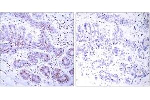 Immunohistochemistry analysis of paraffin-embedded human breast carcinoma tissue, using STAT4 (Ab-693) Antibody.