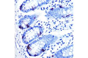 Immunohistochemistry of paraffin-embedded human colon carcinoma using Zinc-α2-glycoprotein (ZAG/) Rabbit mAb (ABIN7265556) at dilution of 1:100 (40x lens). (AZGP1 antibody)