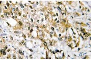 Immunohistochemistry (IHC) analyzes of c-Myc antibody in paraffin-embedded human liver carcinoma tissue. (c-MYC antibody)