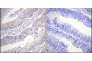 Immunohistochemistry analysis of paraffin-embedded human colon carcinoma tissue, using CFTR (Ab-737) Antibody. (CFTR antibody  (AA 711-760))