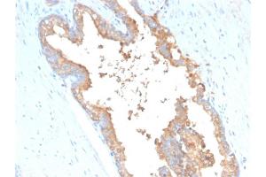 Formalin-fixed, paraffin-embedded human Prostate Carcinoma stained with Transferrin Mouse Monoclonal Antibody (TF/3001). (Transferrin antibody  (AA 311-445))