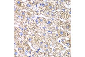 Immunohistochemistry of paraffin-embedded human liver damage using DLST antibody (ABIN6130277, ABIN6139665, ABIN6139667 and ABIN6217240) at dilution of 1:100 (40x lens). (DLST antibody  (AA 1-290))