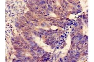Immunohistochemistry of paraffin-embedded human colon cancer using ABIN7159726 at dilution of 1:100 (MGST2 antibody  (AA 27-57))