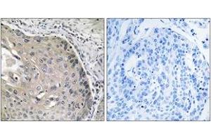 Immunohistochemistry analysis of paraffin-embedded human lung carcinoma tissue, using AOX1 Antibody. (AOX1 antibody  (AA 521-570))