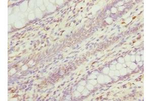 Immunohistochemistry of paraffin-embedded human colon cancer using ABIN7167615 at dilution of 1:100 (RGS5 antibody  (AA 1-181))