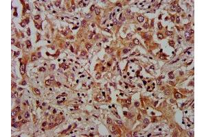 IHC image of ABIN7175929 diluted at 1:1000 and staining in paraffin-embedded human liver cancer performed on a Leica BondTM system. (XKR8 antibody  (AA 69-158))