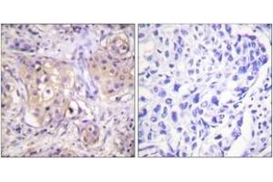 Immunohistochemistry analysis of paraffin-embedded human breast carcinoma, using PKC-pan (Phospho-Thr497) Antibody. (PKC antibody  (pThr497))