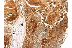 The image on the left is immunohistochemistry of paraffin-embedded Human esophagus cancer tissue using ABIN7192788(THAP9 Antibody) at dilution 1/20, on the right is treated with synthetic peptide. (THAP9 antibody)