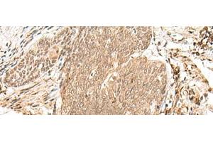 Immunohistochemistry of paraffin-embedded Human esophagus cancer tissue using VPS50 Polyclonal Antibody at dilution of 1:45(x200) (Syndetin/VPS50 antibody)