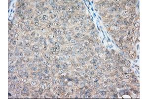 Immunohistochemical staining of paraffin-embedded Adenocarcinoma of Human colon tissue using anti-BSG mouse monoclonal antibody. (CD147 antibody)