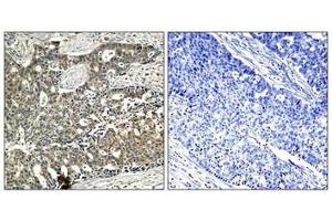 Immunohistochemical analysis of paraffin-embedded human breast carcinoma tissue using p56Dok-2(Phospho-Tyr299) Antibody(left) or the same antibody preincubated with blocking peptide(right). (DOK2 antibody  (pTyr299))