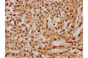IHC image of nhibHU diluted at 1:8 and staining in paraffin-embedded human liver cancer performed on a Leica BondTM system. (HIST1H4A antibody  (AA 1-12))