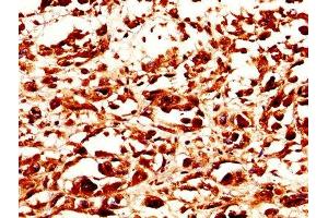 IHC image of ABIN7159229 diluted at 1:200 and staining in paraffin-embedded human melanoma performed on a Leica BondTM system. (Melanoma gp100 antibody  (AA 25-467))