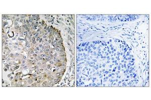 Immunohistochemistry analysis of paraffin-embedded human lung carcinoma tissue, using MRRF antibody. (MRRF antibody  (C-Term))