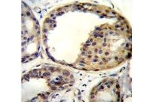 AKT1 antibody immunohistochemistry analysis in formalin fixed and paraffin embedded human breast carcinoma (AKT1 antibody  (AA 282-309))