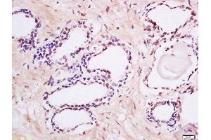 Formalin-fixed and paraffin embedded human prostate labeled with Anti-MAK (Tyr159) Polyclonal Antibody, Unconjugated  at 1:200 followed by conjugation to the secondary antibody and DAB staining. (MAK antibody  (pTyr159))
