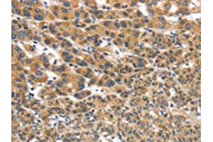The image on the left is immunohistochemistry of paraffin-embedded Human liver cancer tissue using ABIN7192978(UBTD2 Antibody) at dilution 1/35, on the right is treated with synthetic peptide. (UBTD2 antibody)