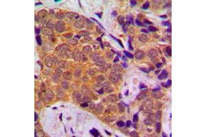 Immunohistochemical analysis of FOXO1 staining in human breast cancer formalin fixed paraffin embedded tissue section. (FOXO1 antibody  (Center))