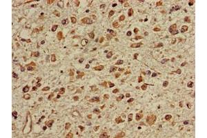 Immunohistochemistry of paraffin-embedded human glioma using ABIN7150673 at dilution of 1:100 (TGDS antibody  (AA 143-305))
