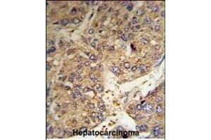 FGG Antibody (C-term) (R) IHC analysis in formalin fixed and paraffin embedded human hepatocarcinoma tissue followed by peroxidase conjugation of the secondary antibody and DAB staining. (FGG antibody  (C-Term))