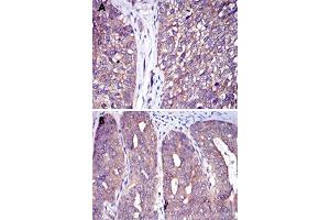Immunohistochemical analysis of paraffin-embedded human ovarian cancer (A) and human bladder cancer (B) tissues using CBL monoclonal antibody, clone 3B12  with DAB staining. (CBL antibody)