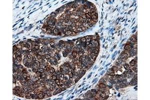 Immunohistochemical staining of paraffin-embedded Adenocarcinoma of breast tissue using anti-XRCC1 mouse monoclonal antibody. (XRCC1 antibody)