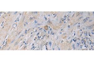 Immunohistochemistry of paraffin-embedded Human gastric cancer tissue using HSDL2 Polyclonal Antibody at dilution of 1:55(x200)