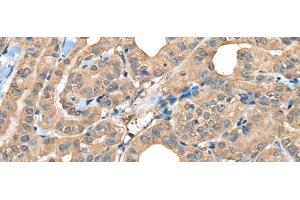 Immunohistochemistry of paraffin-embedded Human thyroid cancer tissue using CABP5 Polyclonal Antibody at dilution of 1:65(x200) (CABP5 antibody)