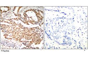 Immunohistochemical analysis of paraffin-embedded human breast carcinoma tissue using MEF2A (phospho S408) polyclonal antibody . (MEF2A antibody  (pSer408))