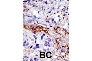 Formalin-fixed and paraffin-embedded human cancer tissue reacted with the primary antibody, which was peroxidase-conjugated to the secondary antibody, followed by DAB staining. (USP21 antibody  (C-Term))