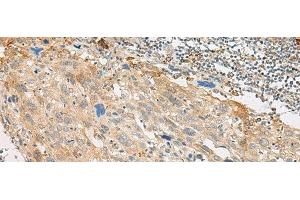 Immunohistochemistry of paraffin-embedded Human cervical cancer tissue using GPR151 Polyclonal Antibody at dilution of 1:45(x200) (GPR151 antibody)