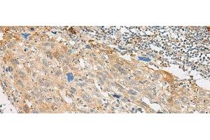 Immunohistochemistry of paraffin-embedded Human cervical cancer tissue using GPR151 Polyclonal Antibody at dilution of 1:45(x200) (GPR151 antibody)